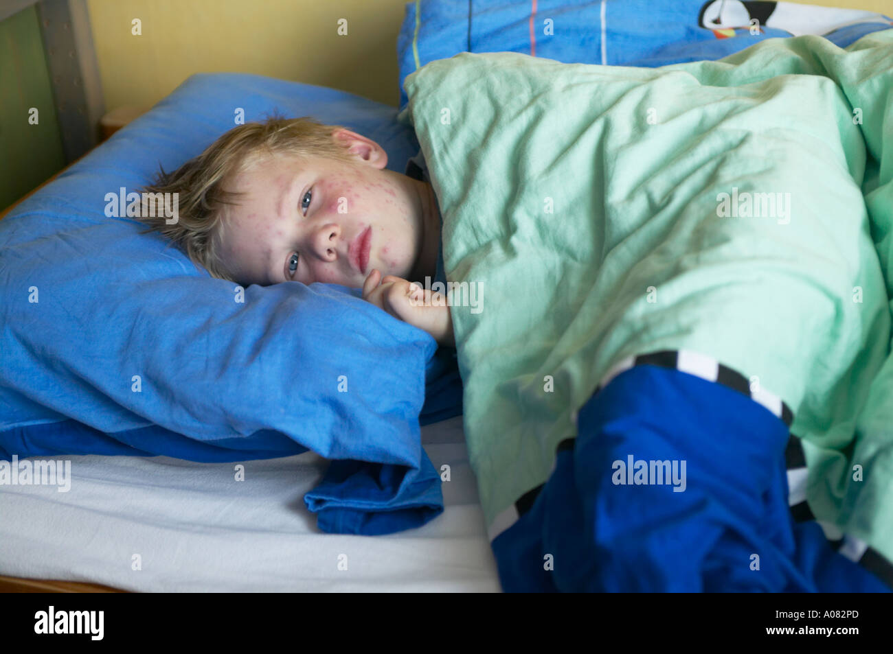 Young boy sick with chicken pox on his bed DEU GERMANY Stock Photo