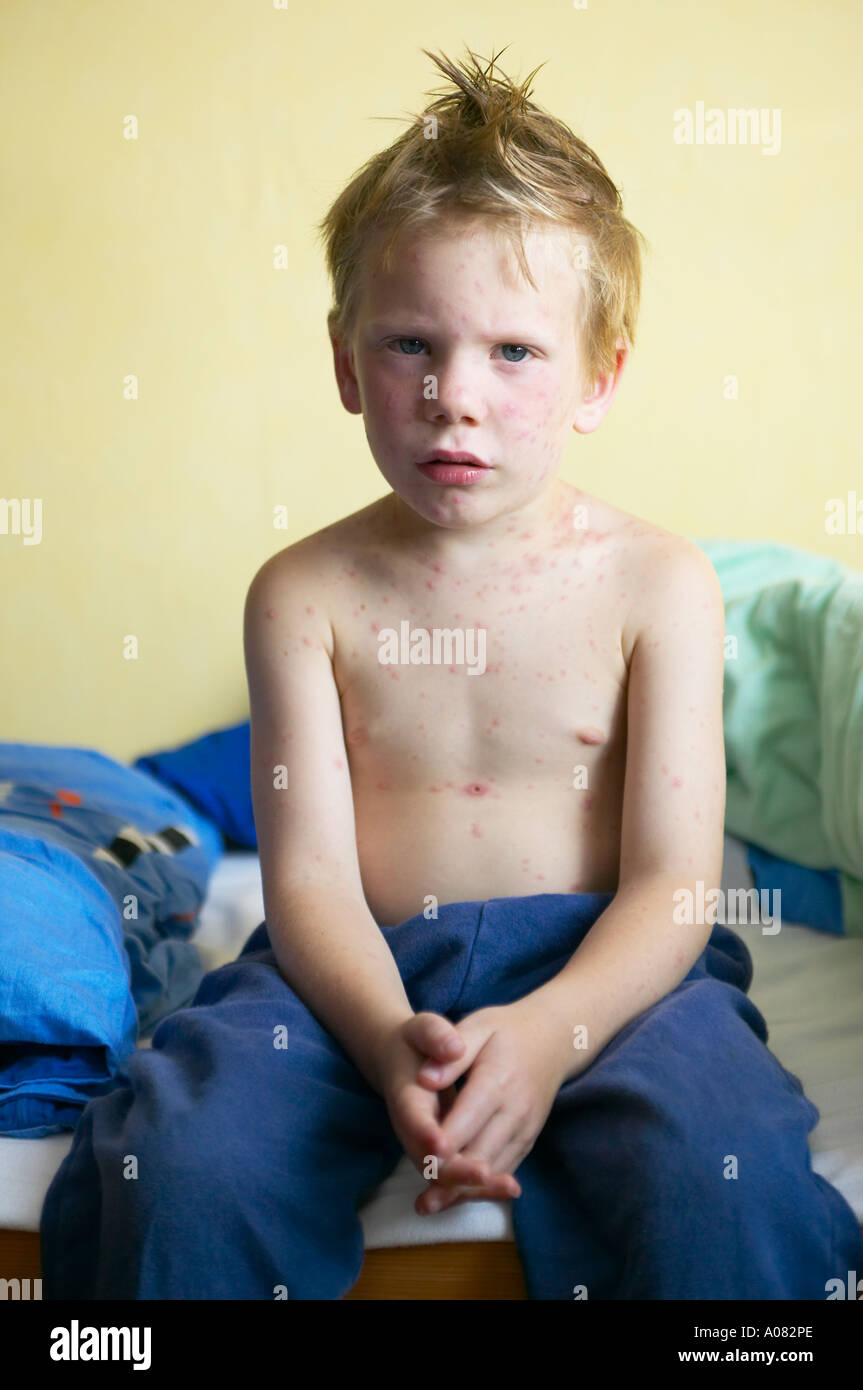 Young boy sick with chicken pox on his bed DEU GERMANY Stock Photo