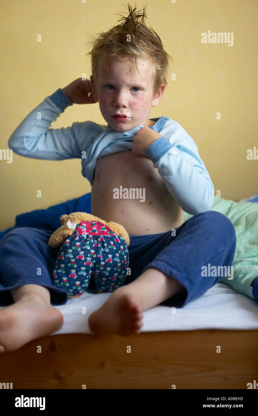 Young boy sick with chicken pox on his bed DEU GERMANY Stock Photo