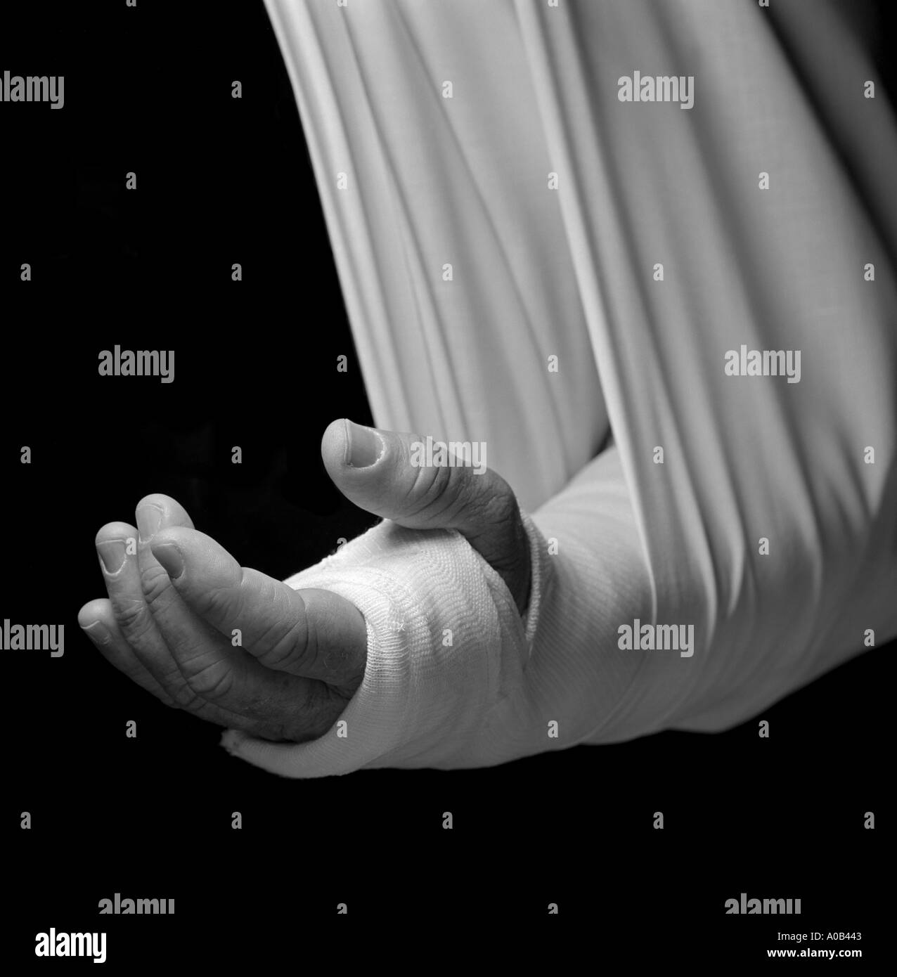 broken arm Stock Photo - Alamy