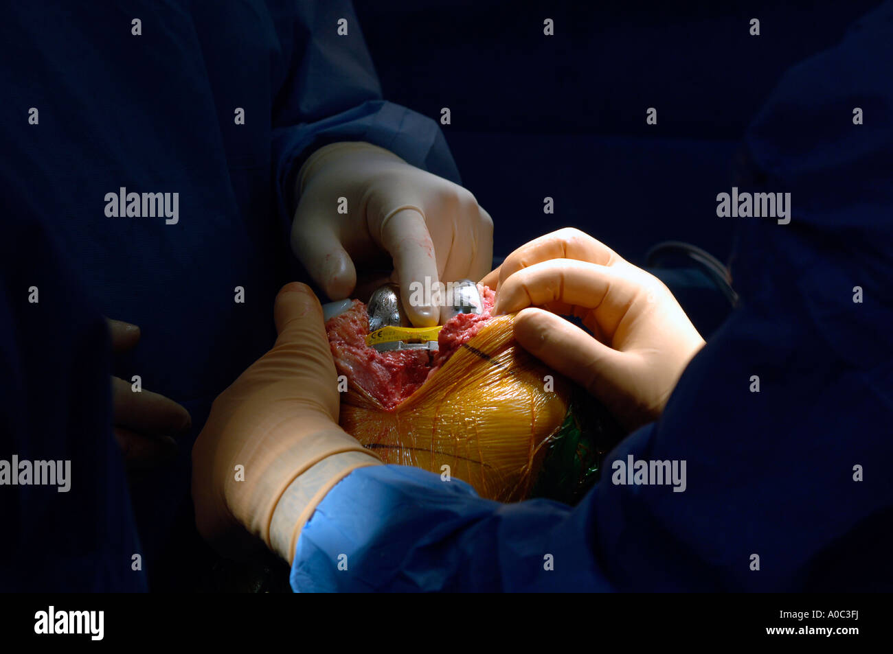 Total right knee replacement operation using a gender specific prosthetic appliance for women Appliance is postioned Stock Photo