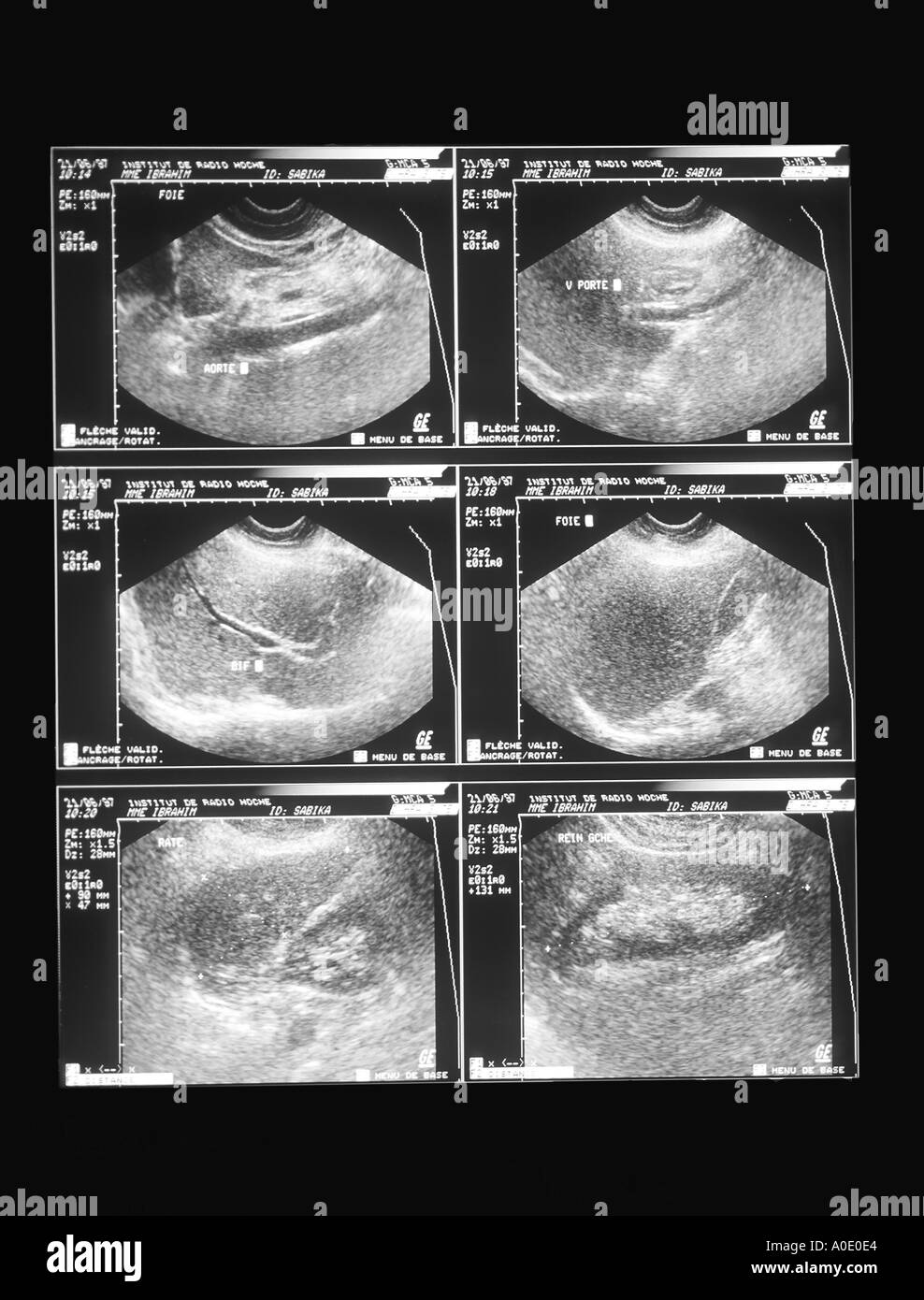 Abdominal Ultrasound Scan Stock Photo