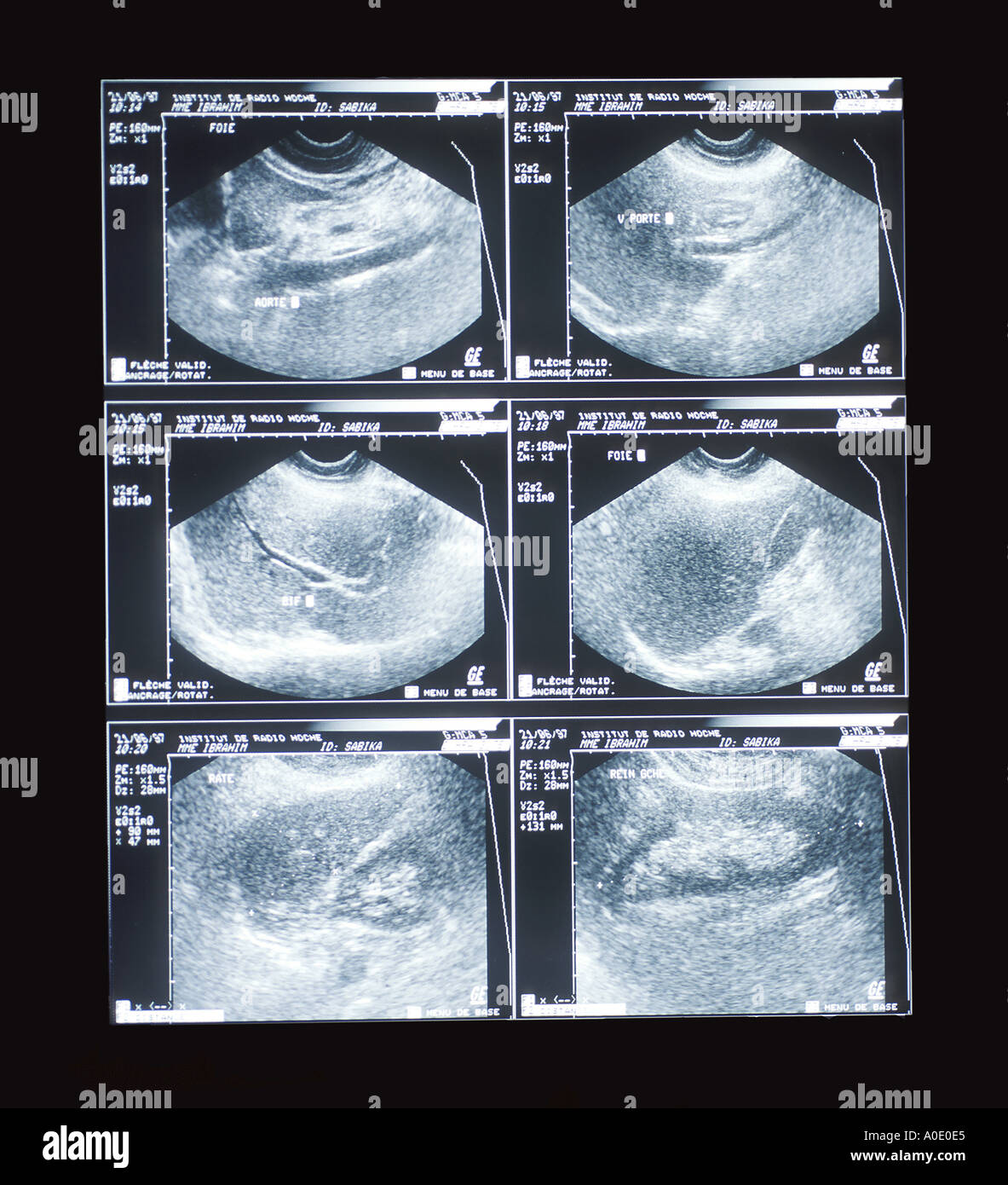 Abdominal Ultrasound Scan Stock Photo