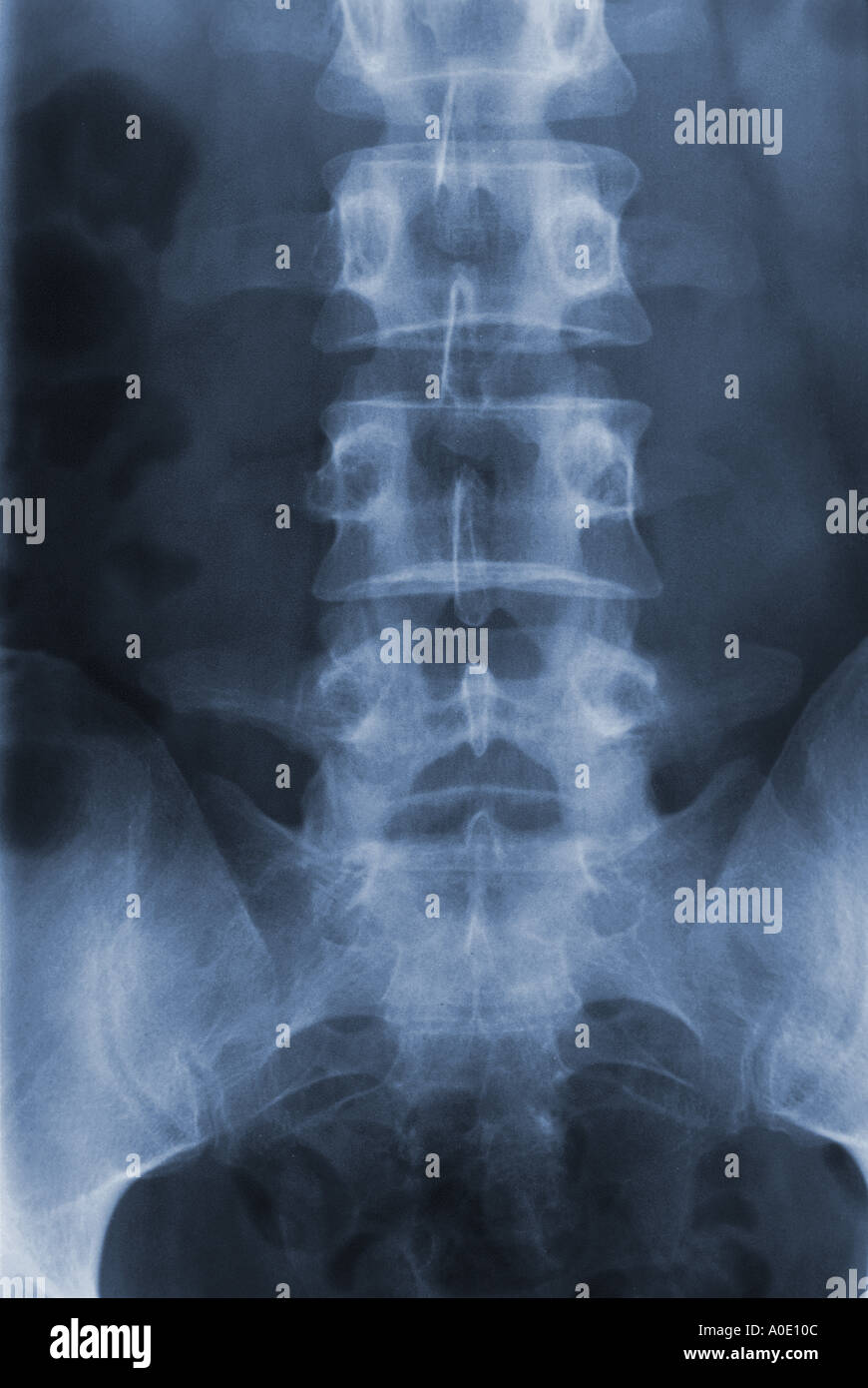 X ray of Lumbar Spine Stock Photo - Alamy