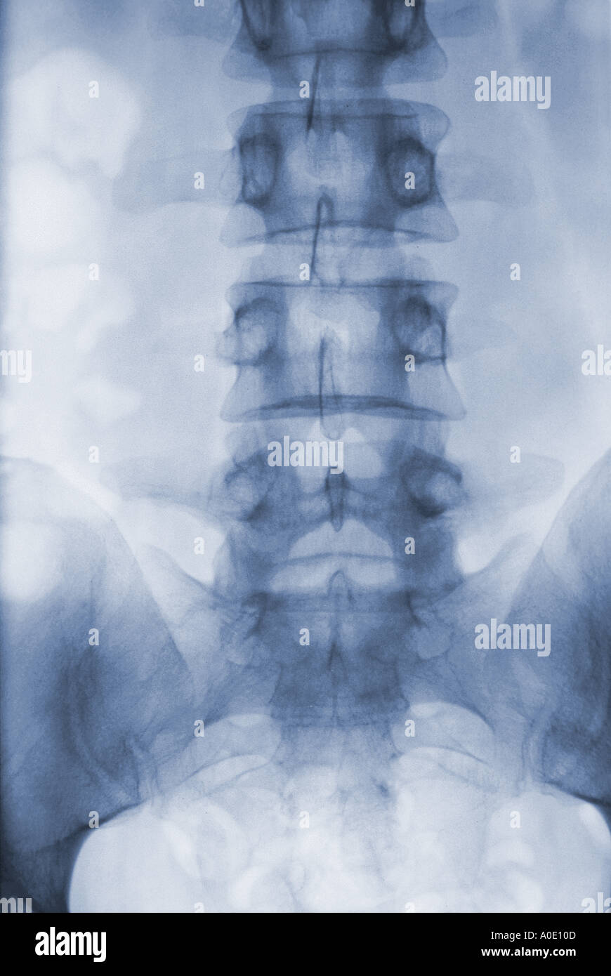 X ray of Lumbar Spine Stock Photo - Alamy
