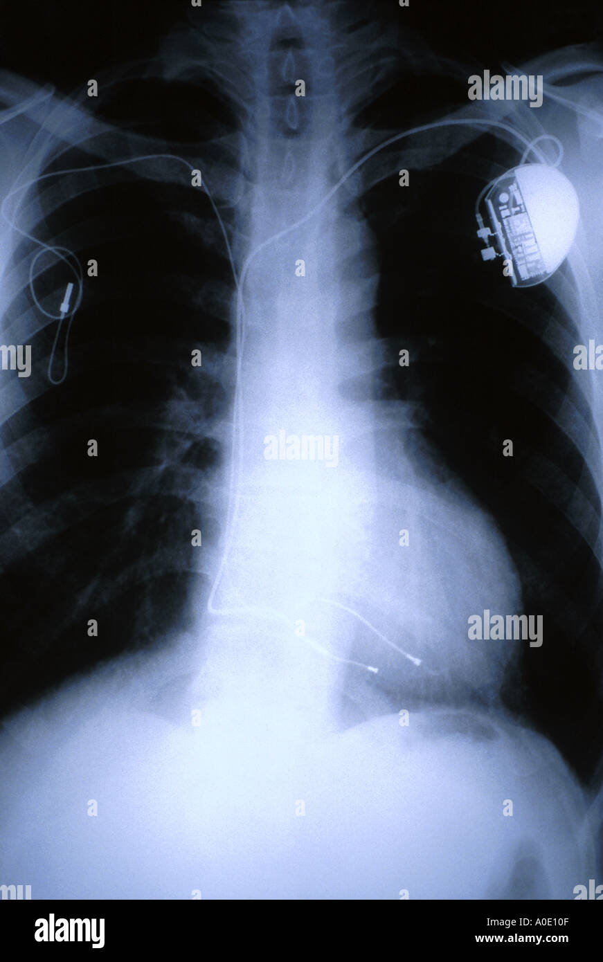 X ray of heart Pacemaker Stock Photo Alamy