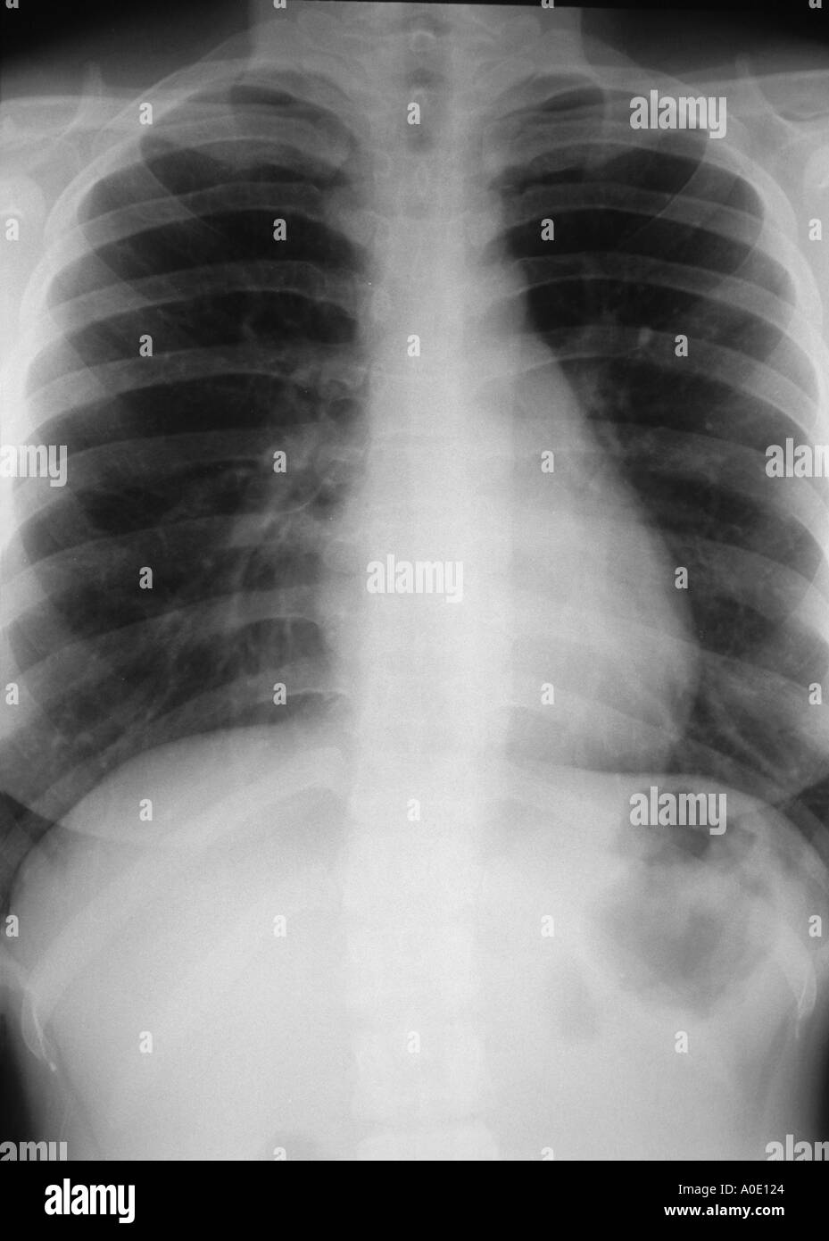 Chest X Ray Stock Photo Alamy