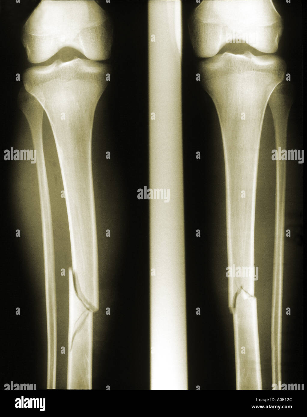 Broken leg xray hi-res stock photography and images - Alamy
