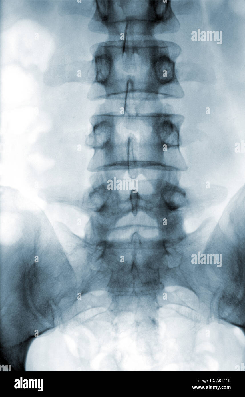 Spine X ray Stock Photo Alamy