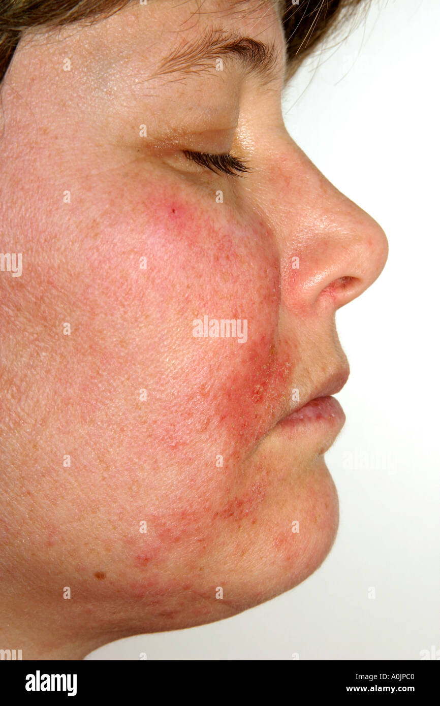 Shingles face