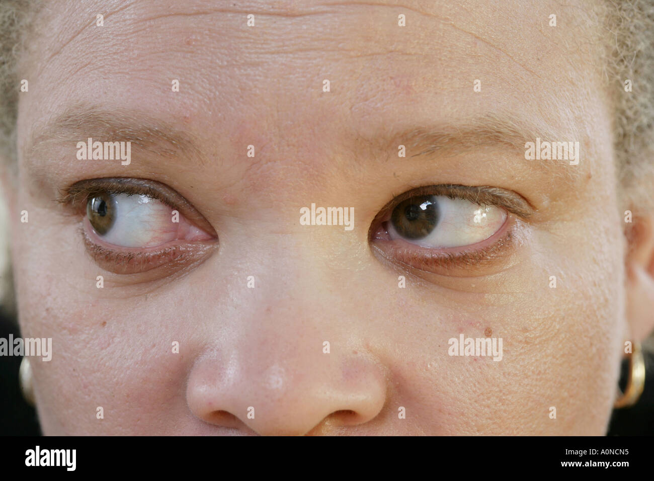 Part of a series of nine gaze positions.Search on CMSP NYSTAGMUS to see the entire series. Stock Photo