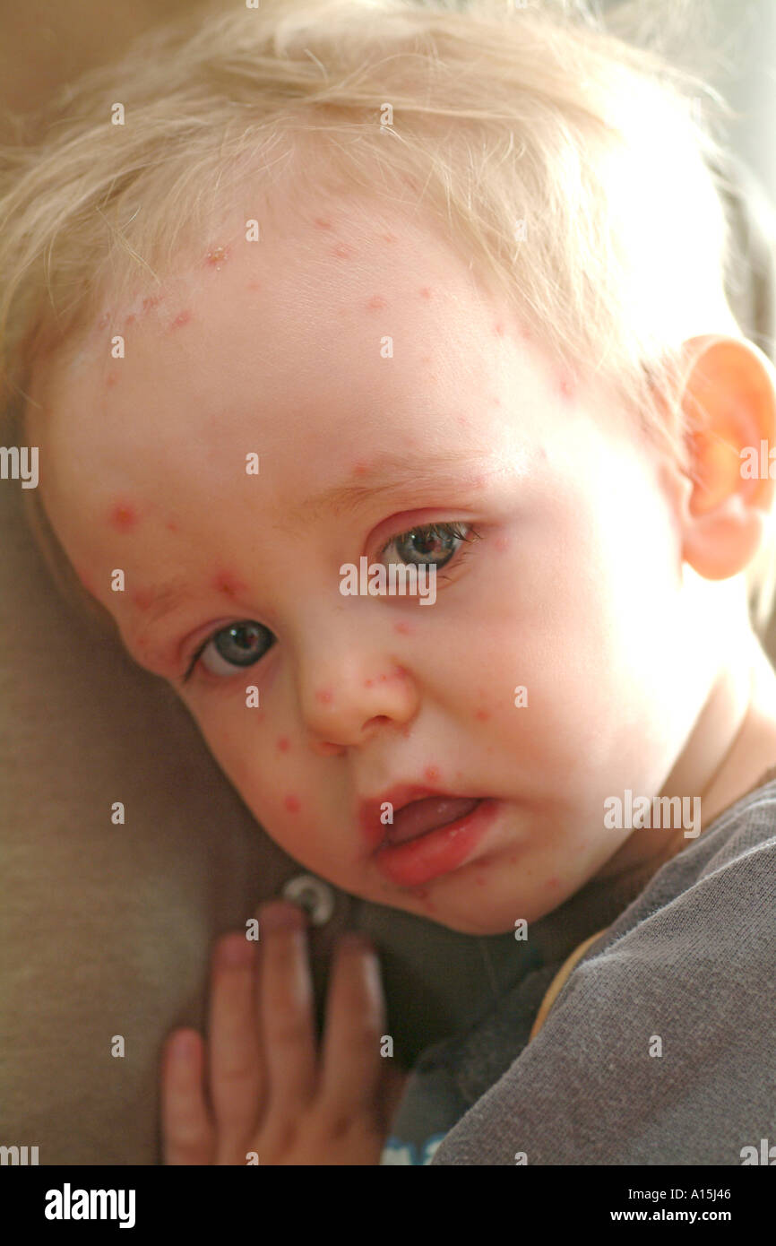 child with chicken pox Stock Photo - Alamy
