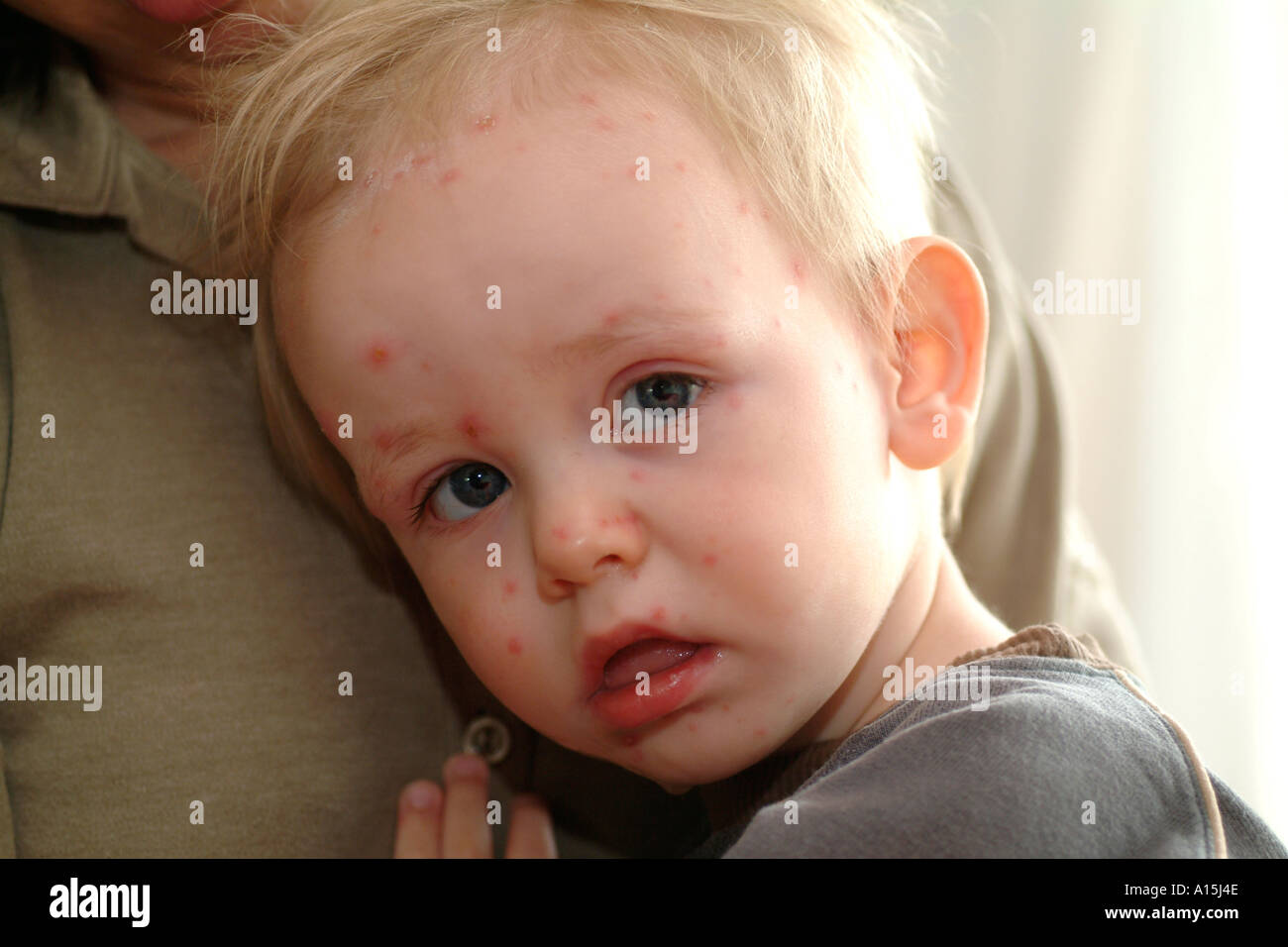 child with chicken pox Stock Photo - Alamy