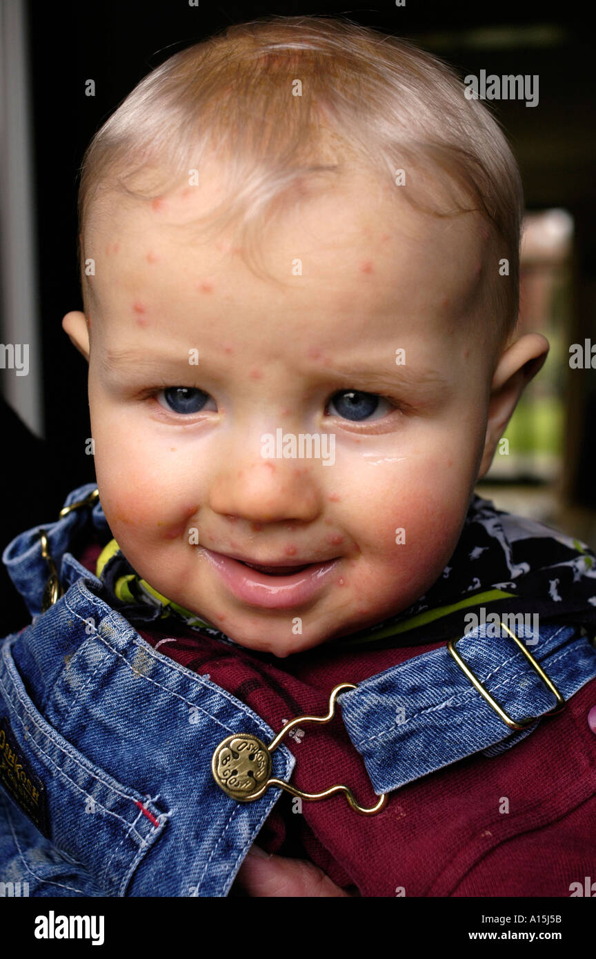 child with chicken pox Stock Photo - Alamy