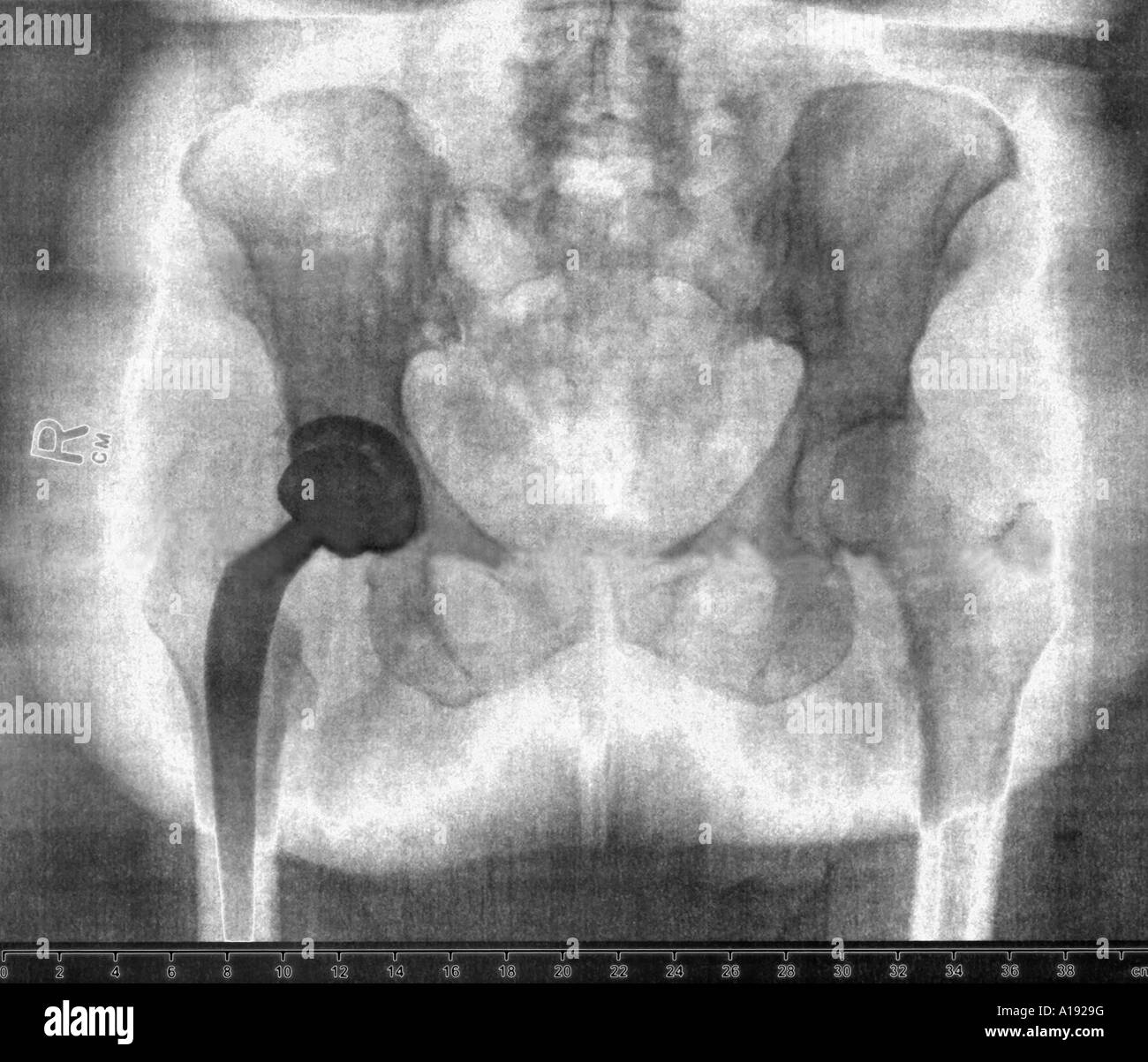 Artificial hip Stock Photo