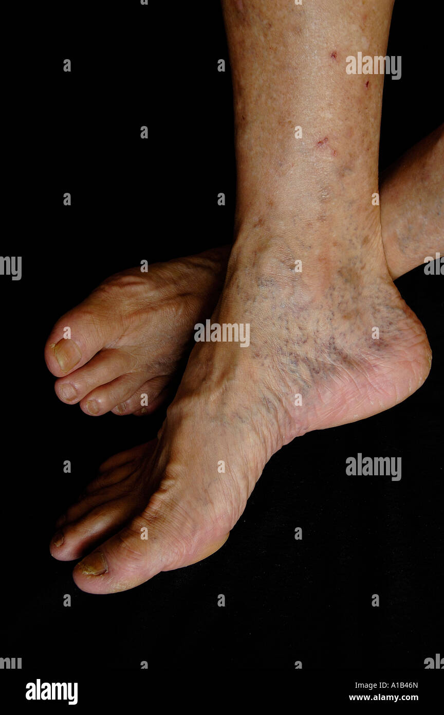Elderly feet with deep vein thrombosis DVT Stock Photo