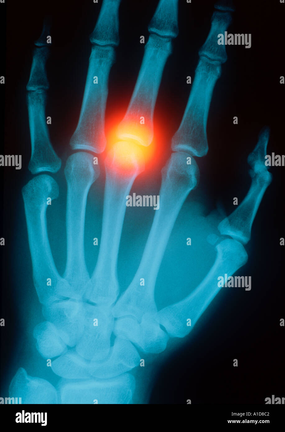 Human Knuckles X Rey hand x ray with highlighted knuckle Stock Photo - Alamy