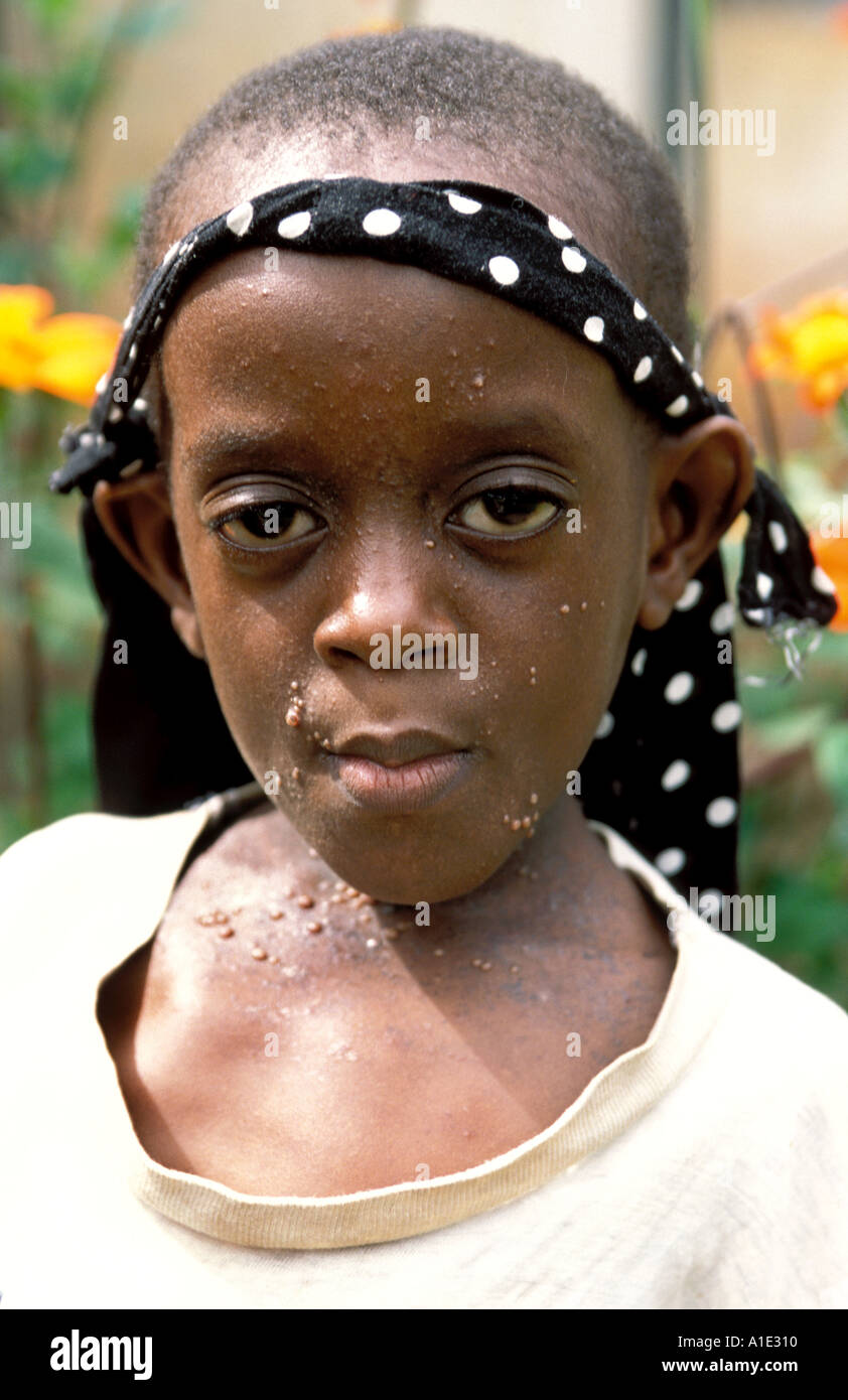 Uganda patients dying of HIV Aids supported by Hospice Uganda