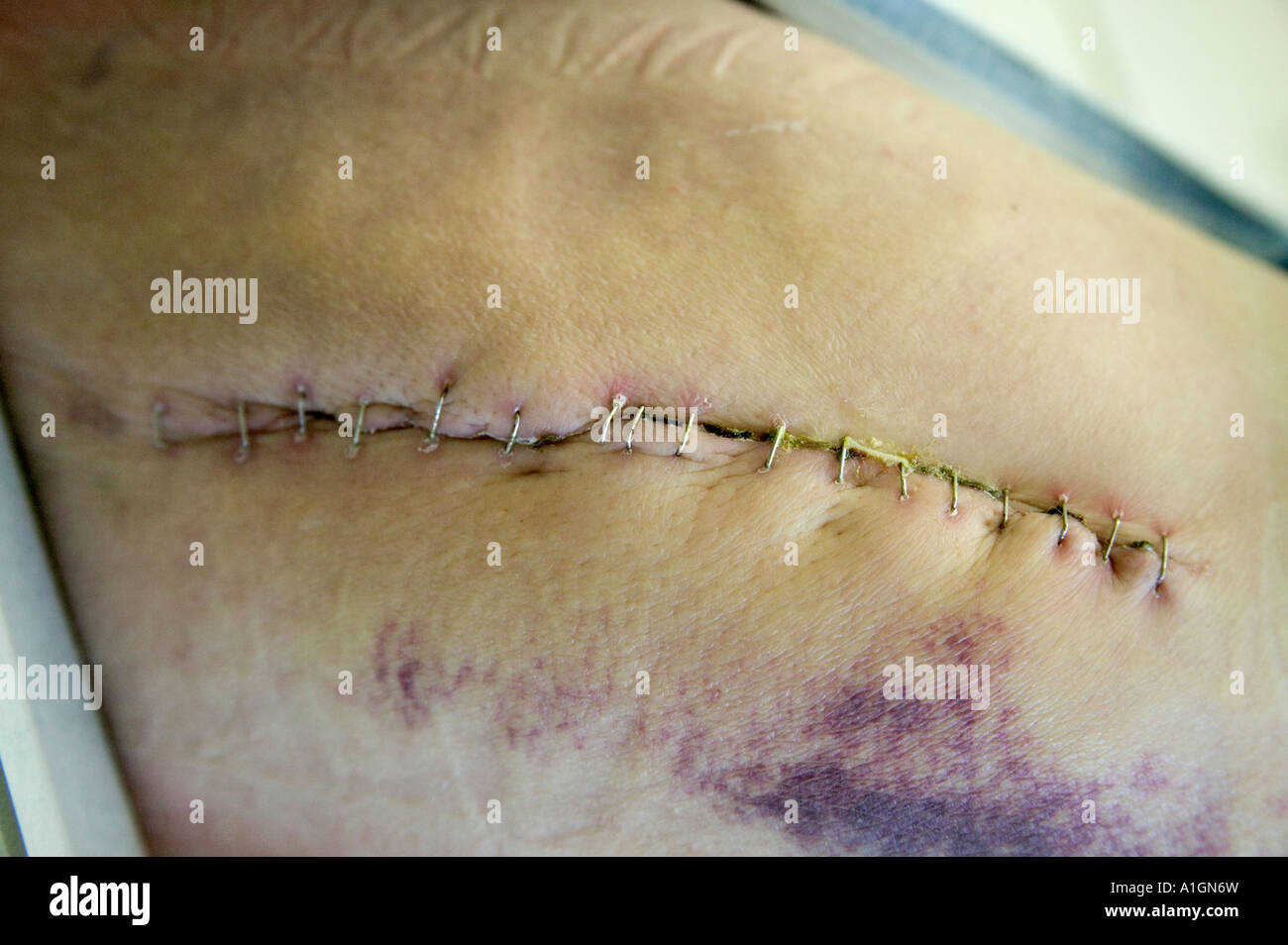 Incision with stainless steel surgical staples, total right hip arthroplasty Stock Photo