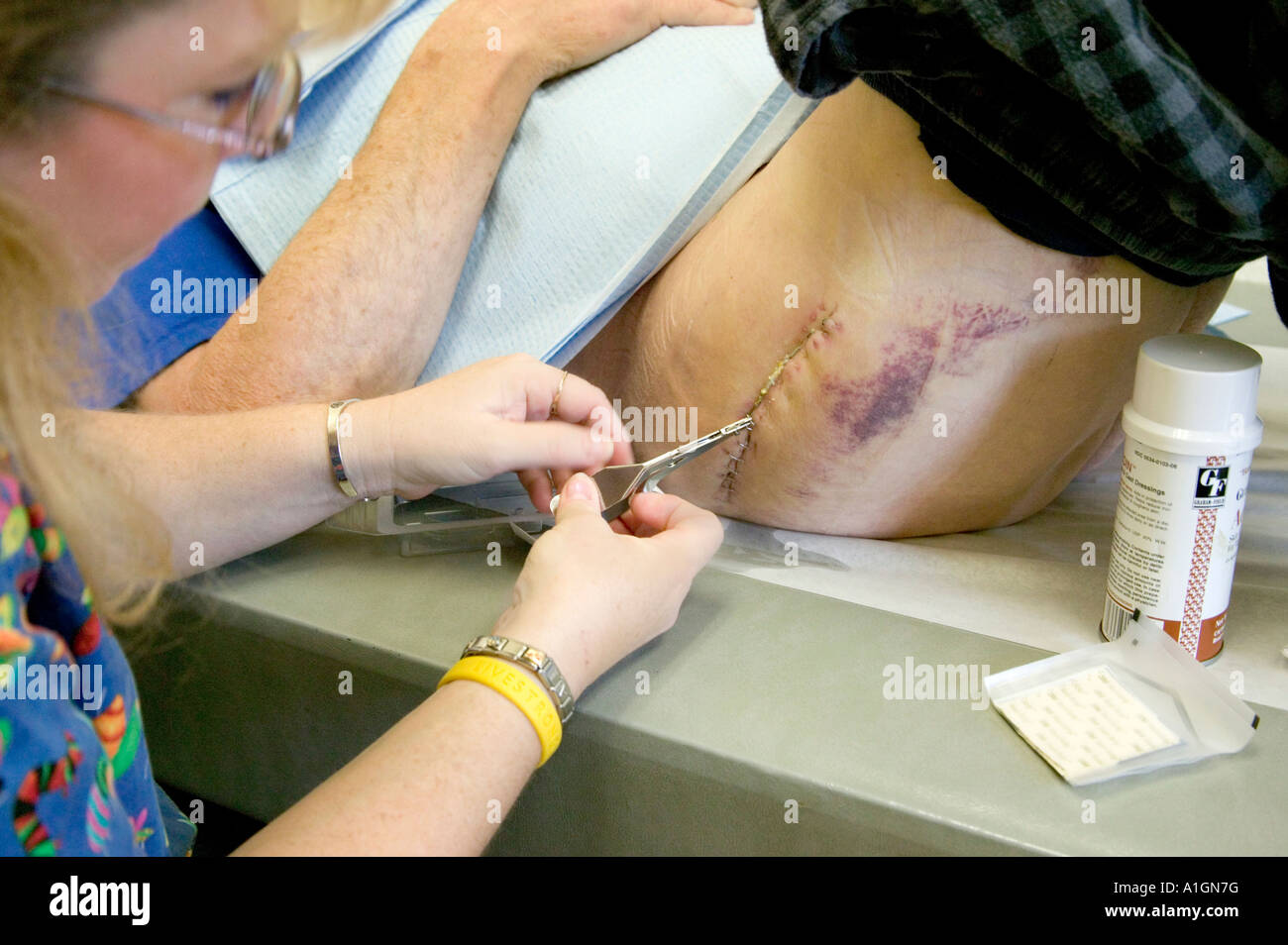 nurse, hip, staplesNurse removing stainless steel surgical staples from  total right hip arthroplasty. Stock Photo