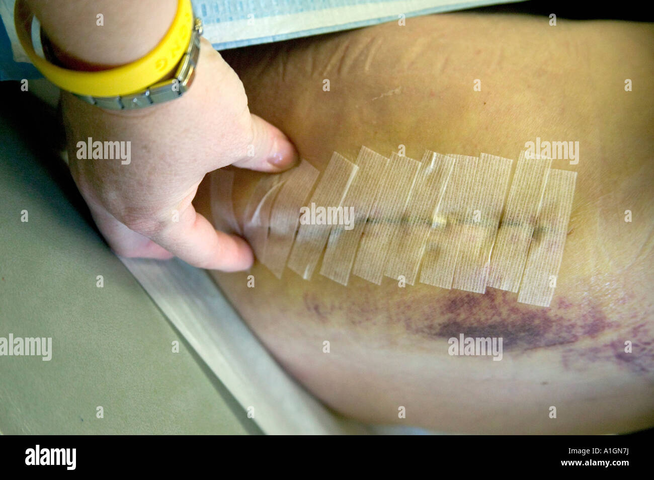 Incision with butterfly strips, total right hip arthroplasty Stock Photo