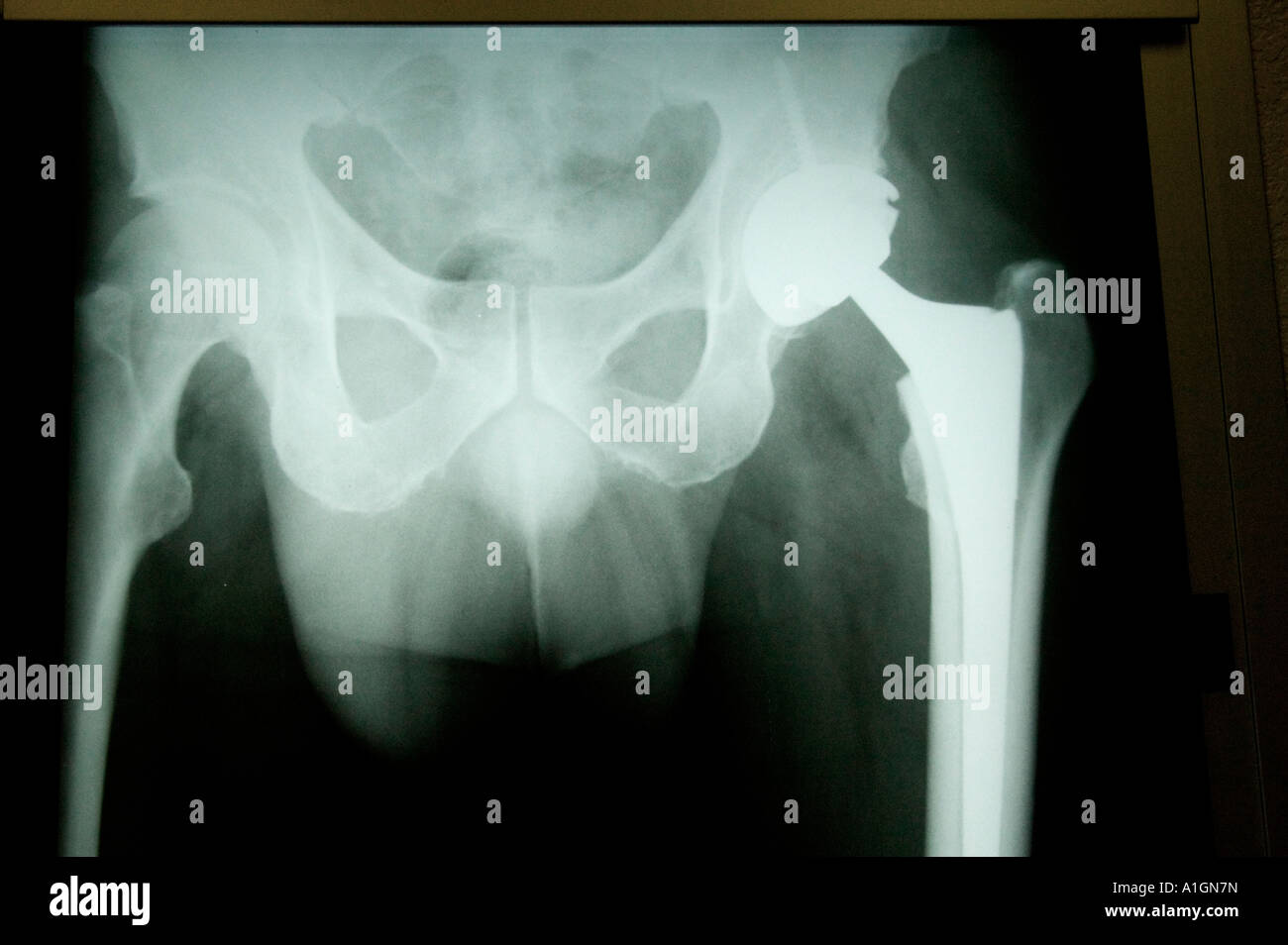 X-ray of total right hip arthroplasty, hip replacement Stock Photo