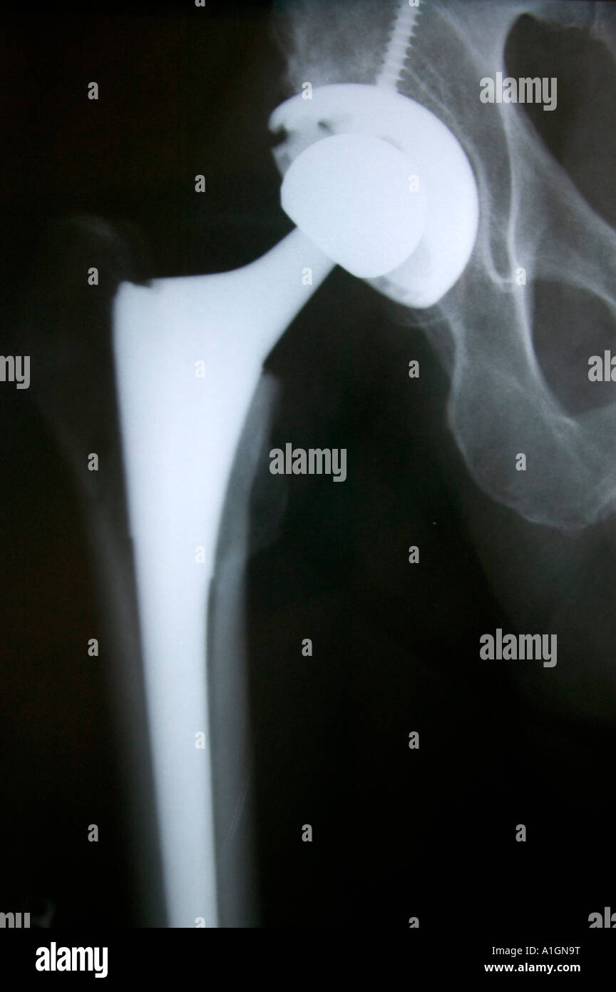 X-ray total right hip arthroplasty replacement Stock Photo