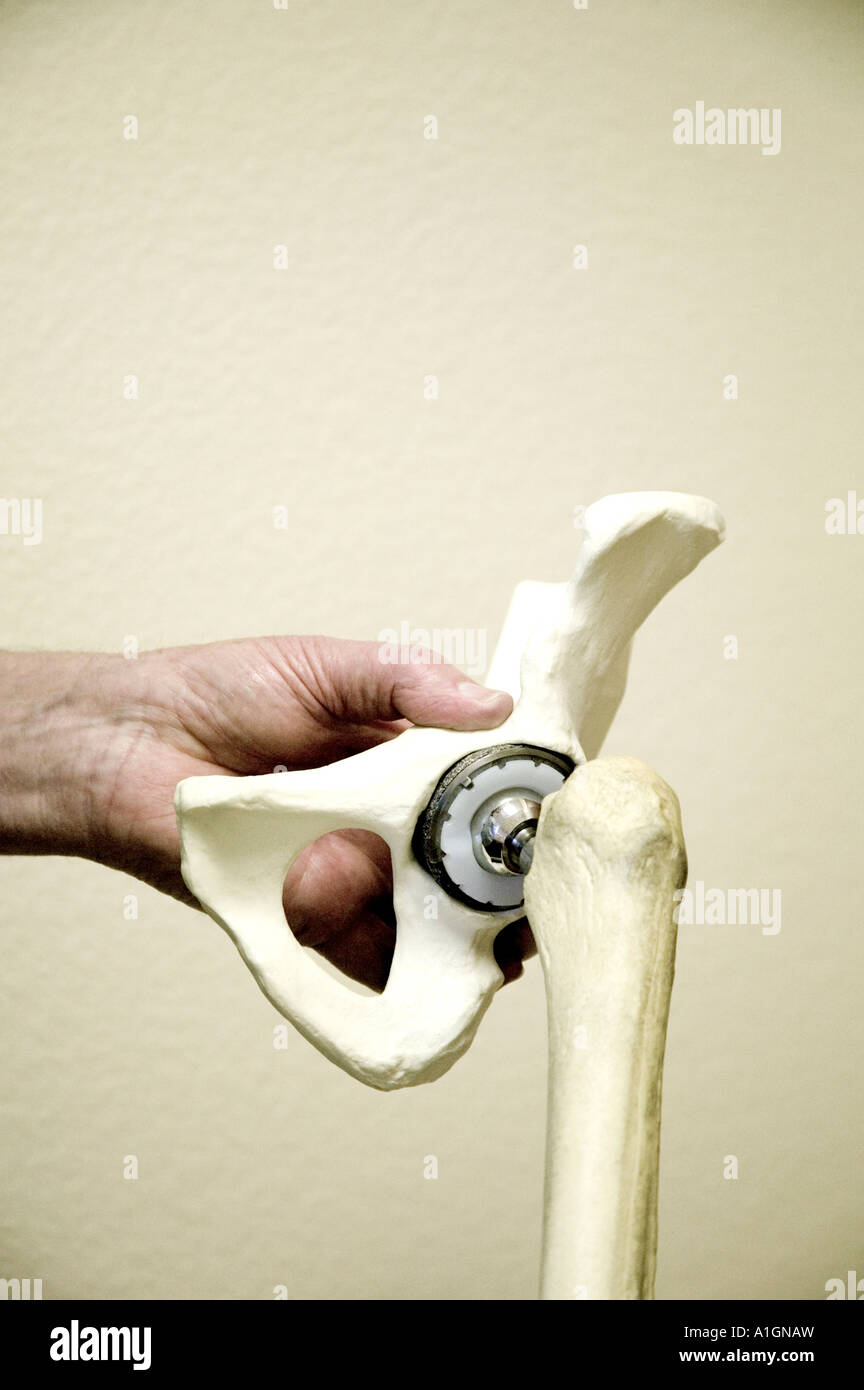 Hand displaying hip replacement 'prosthesis',  nevada Stock Photo
