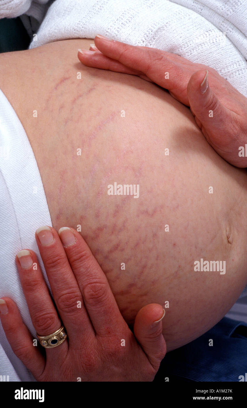 heavily pregnant tummy with stretch marks Stock Photo