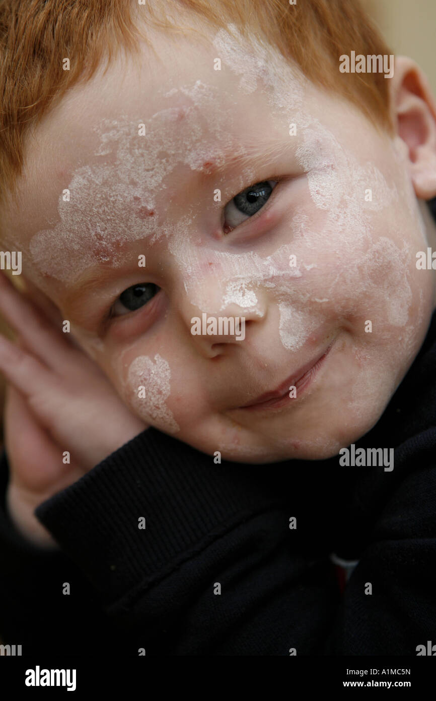 Child with chicken pox spots on face and calamine lotion Stock Photo