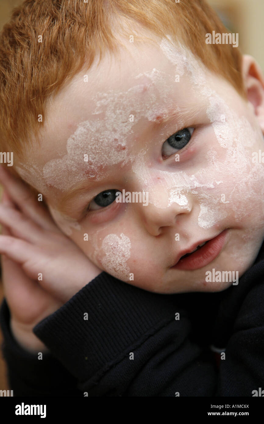Calamine lotion hi-res stock photography and images - Alamy