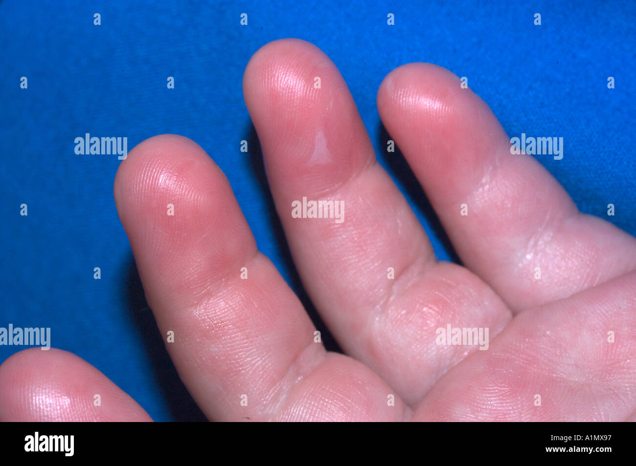 viral exanthem from hand foot and mouth disease Stock Photo: 3361430
