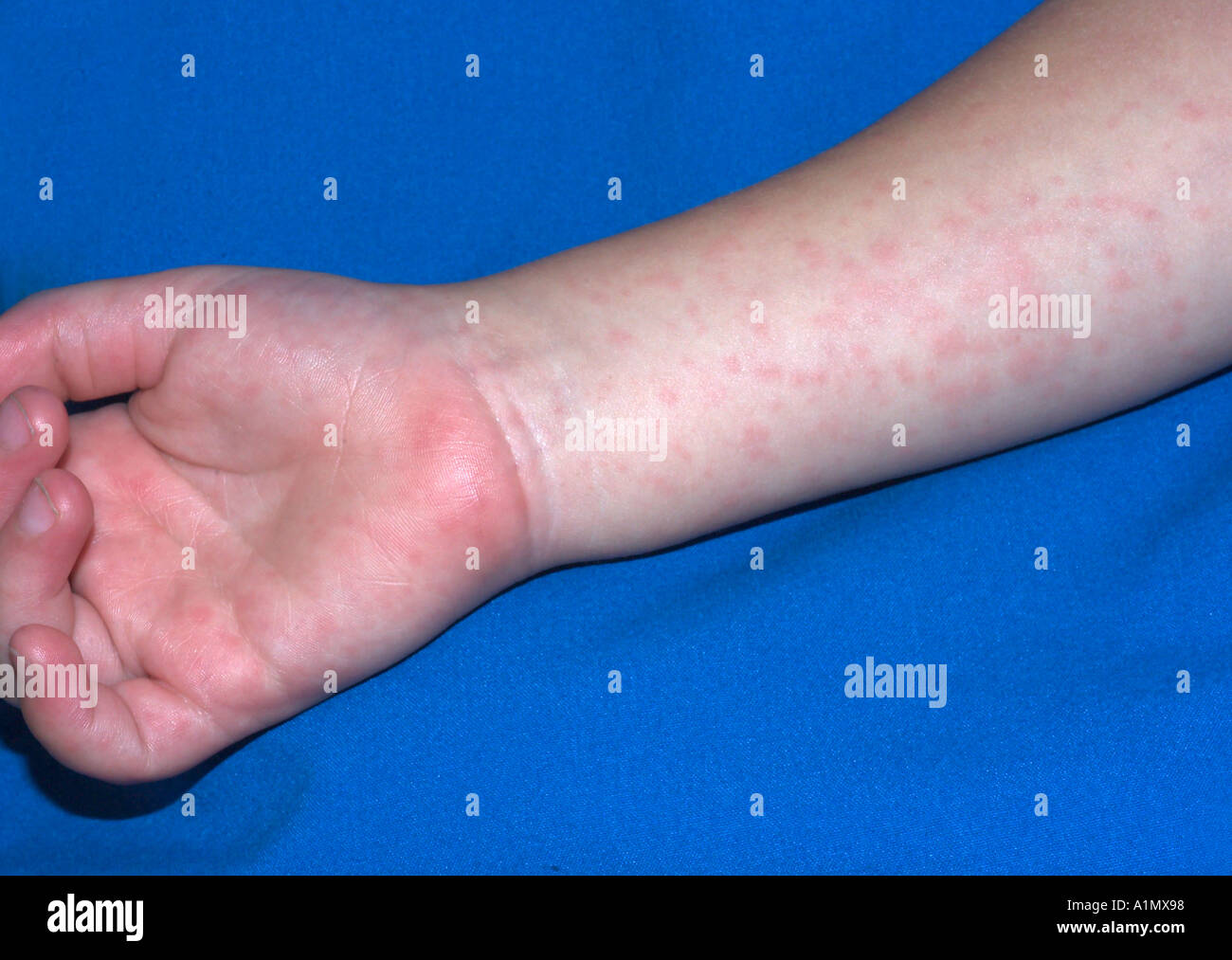 viral exanthem from hand foot and mouth disease Stock Photo Alamy