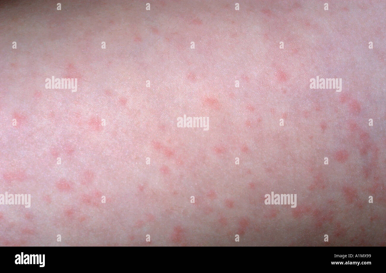 Viral exanthem from hand foot and mouth disease stock photo 3361432