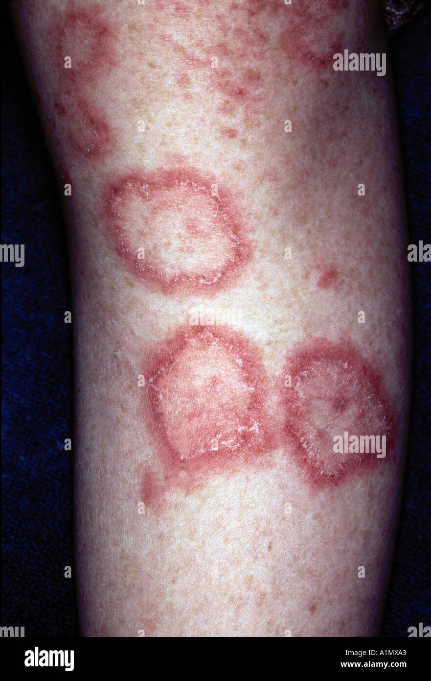 lupus skin rash Stock Photo - Alamy
