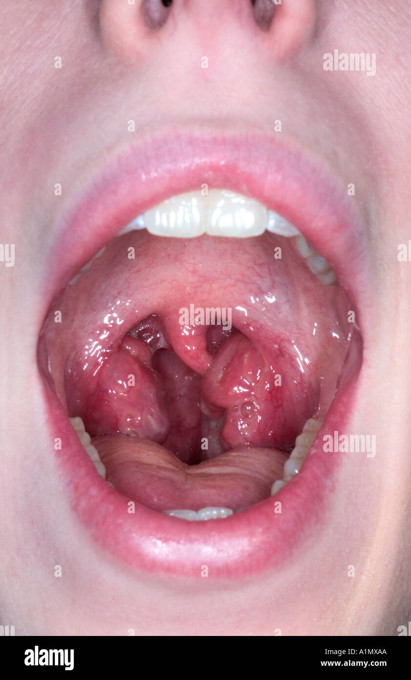 strep throat infection Stock Photo