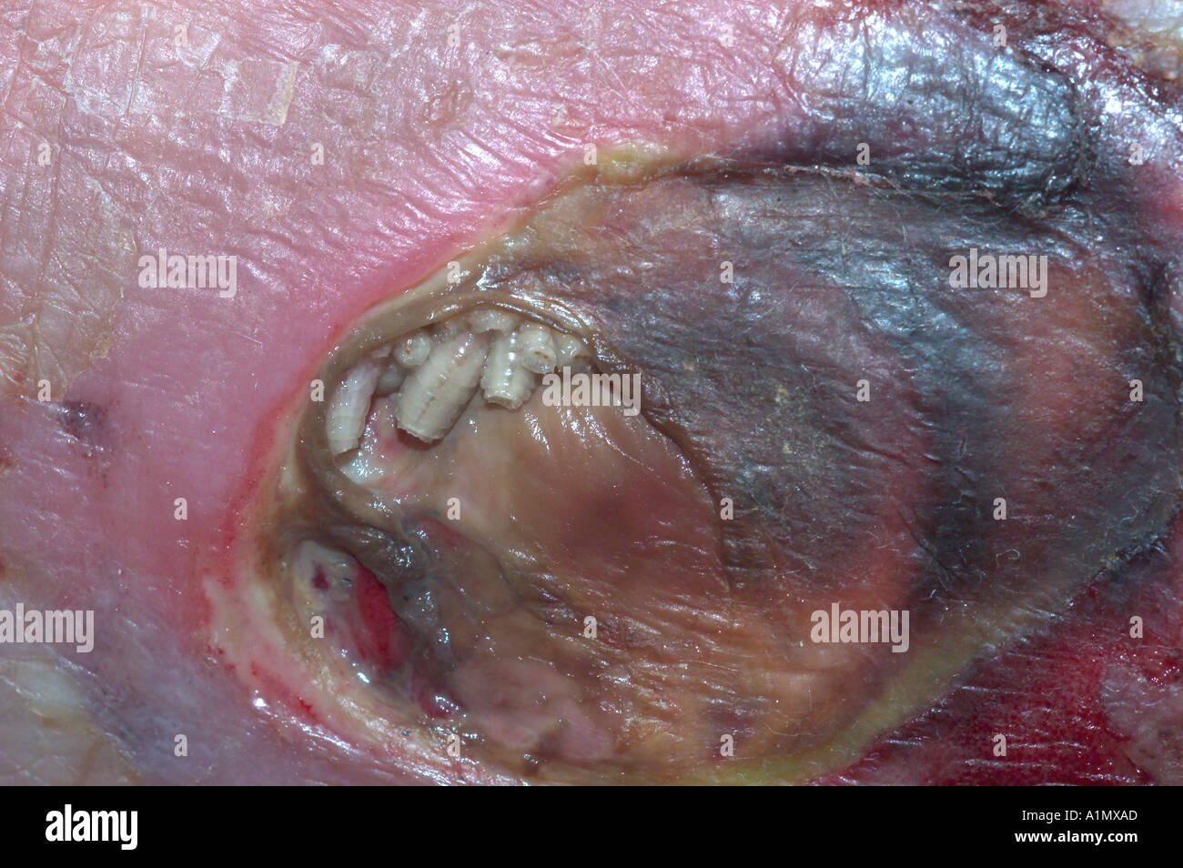 fly maggots found in ankle wound ulcer of elderly male Stock Photo