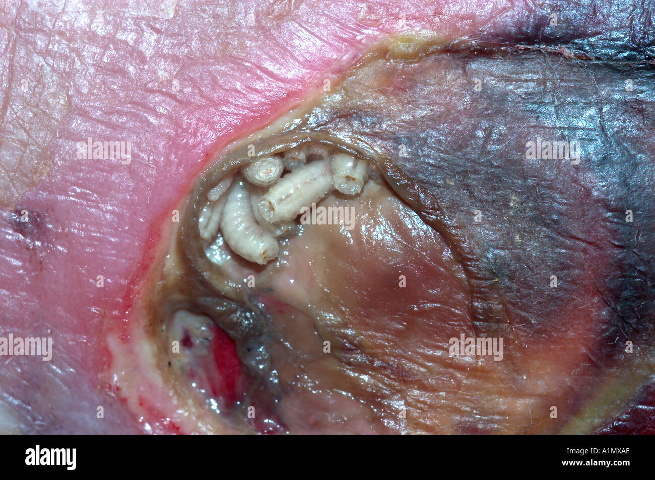 fly maggots found in ankle wound ulcer of elderly male Stock Photo - Alamy