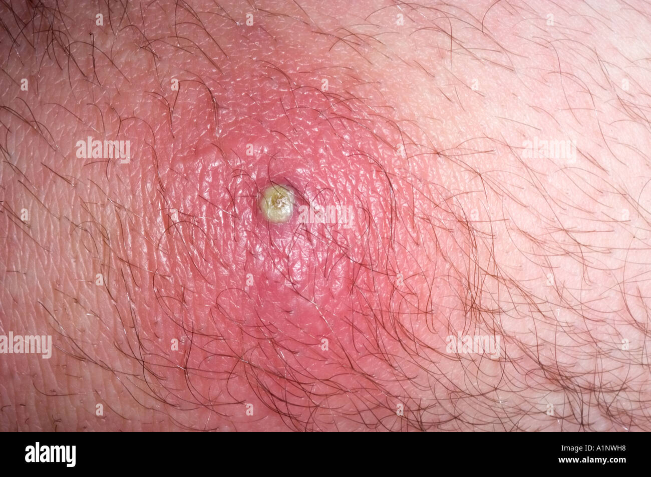 Staphylococci On The Surface Of Skin Stock Photo - Download Image Now -  Staphylococcus, MRSA, Bacterium - iStock