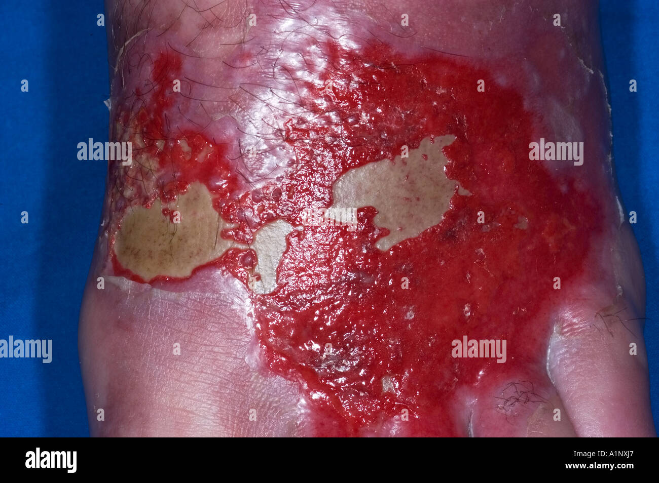 burn on the dorsum of the foot of 21 year old male who spilled hot grease on his foot Stock Photo