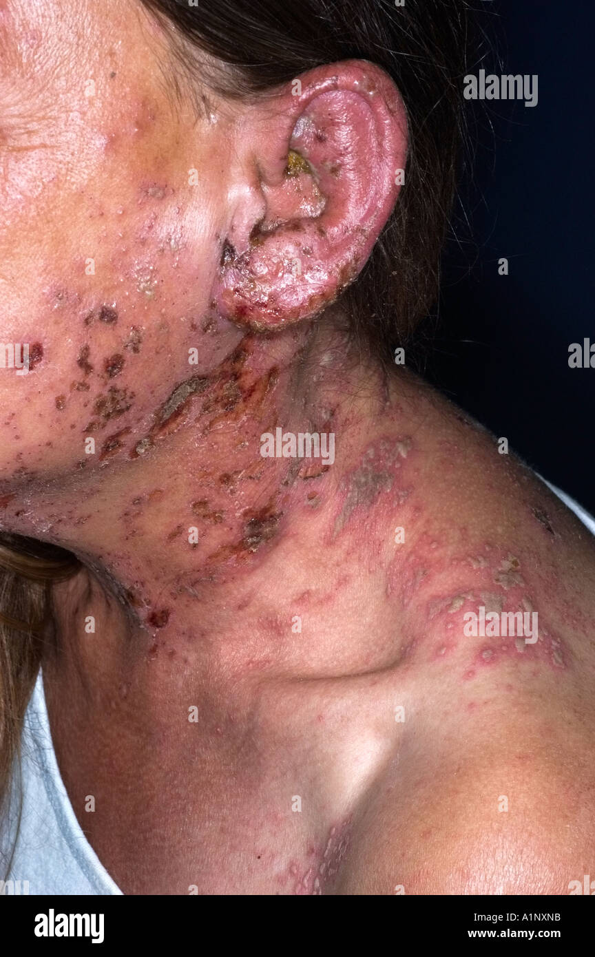 Herpes Zoster Infection Of The Left Side Of The Face And Ear Stock