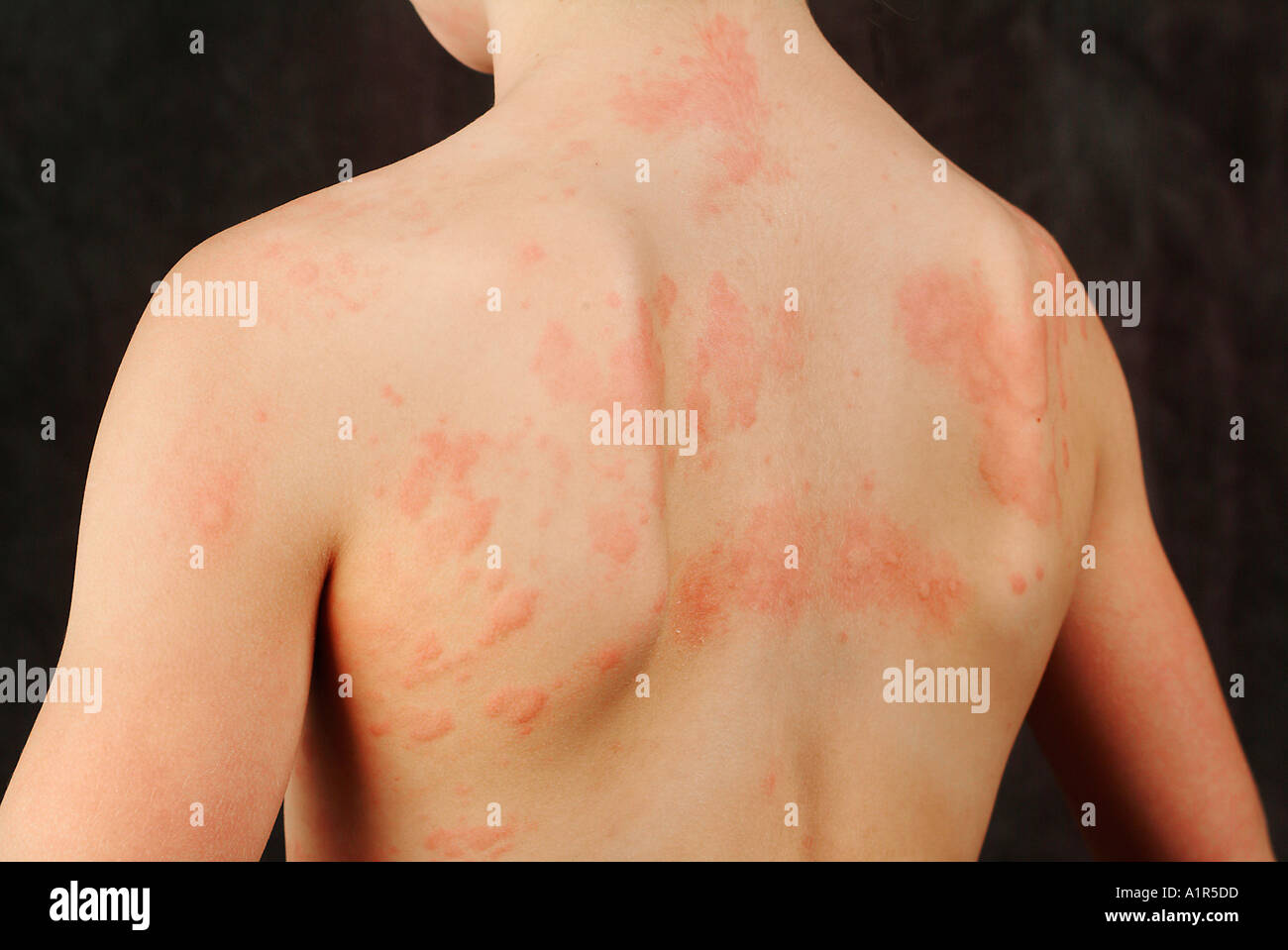 Hives Produced from a Strep Infection Stock Photo