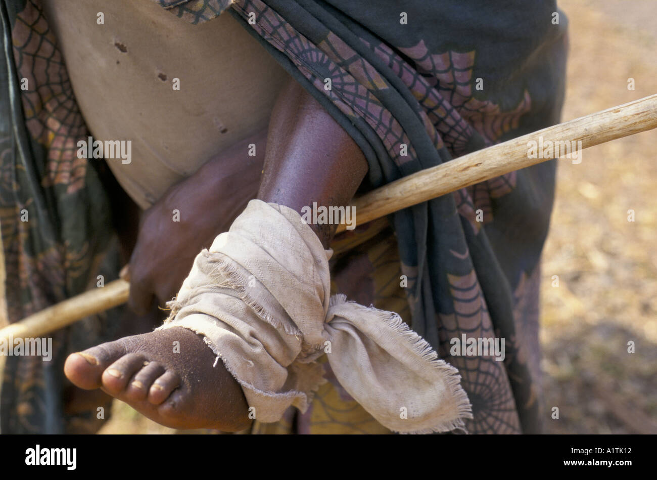 RWANDAN REFUGEE CHILD WITH SWOLLEN FEET CAUSED BY WALKING ON TARMAC ROADS BEING CARRIED BY PARENT ZAIRE AUG SEPT 1994 Stock Photo