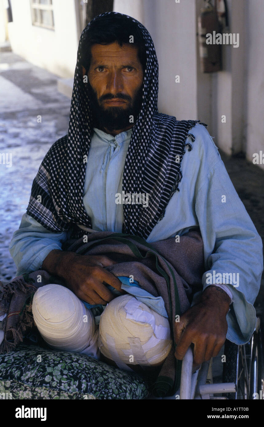 MINES IN AFGHANISTAN . MINE VICTIM HABIBULLAH ICRC (INTERNATIONAL COMMITTEE OF THE RED CROSS ) HOSPITAL KABUL 1996 Stock Photo