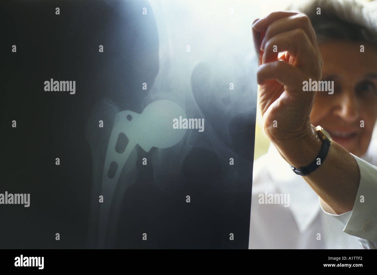 NHS HOSPITAL HIP REPLACEMENT REPLACEMENT PATIENT S X RAY Stock Photo