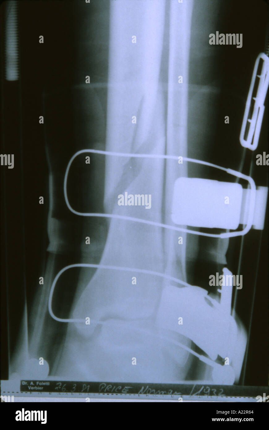 Broken Leg in Ski Boot Stock Photo