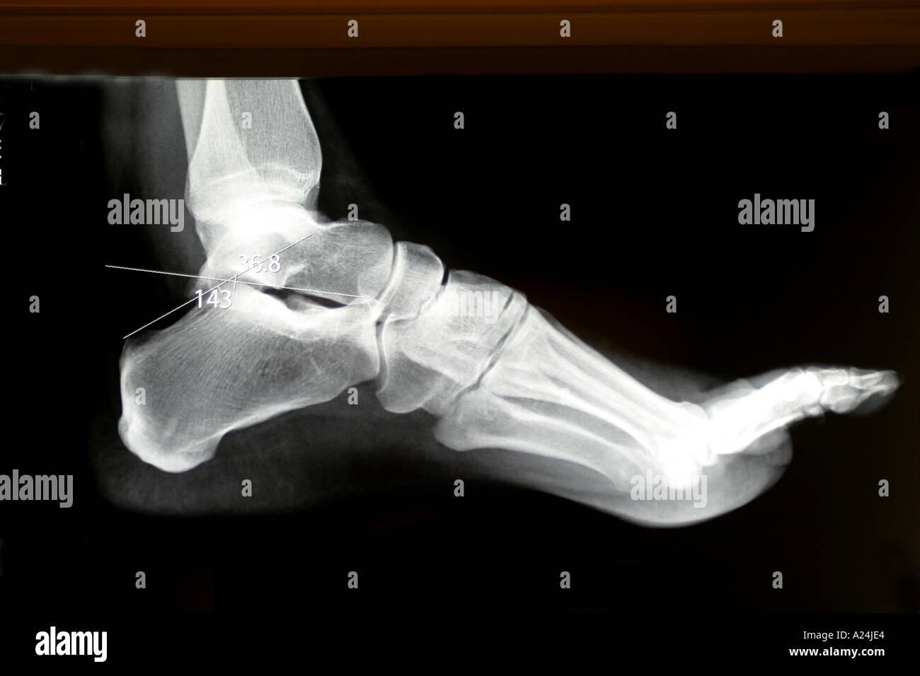 X ray of a foot Stock Photo - Alamy