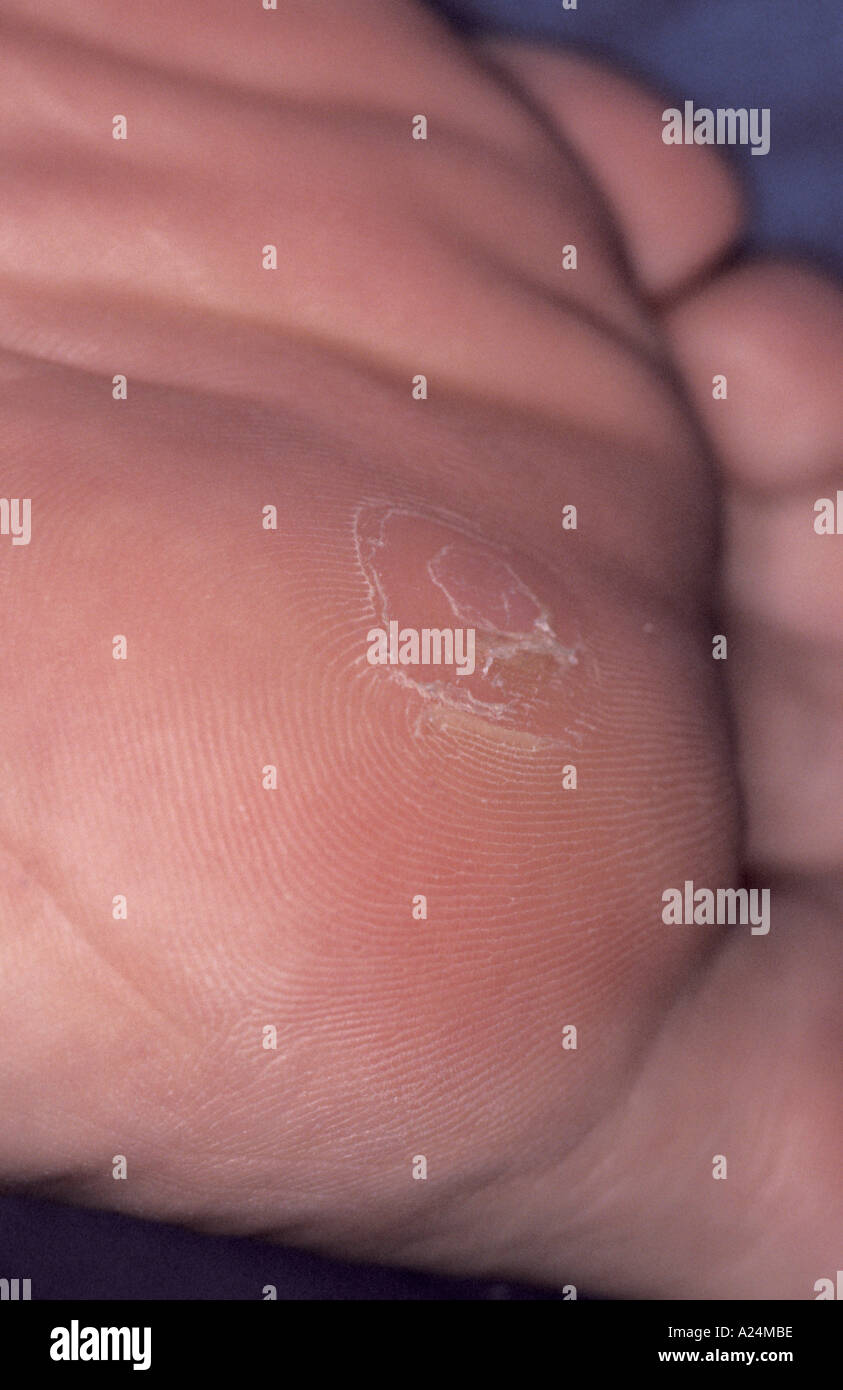 Blister foot hires stock photography and images Alamy