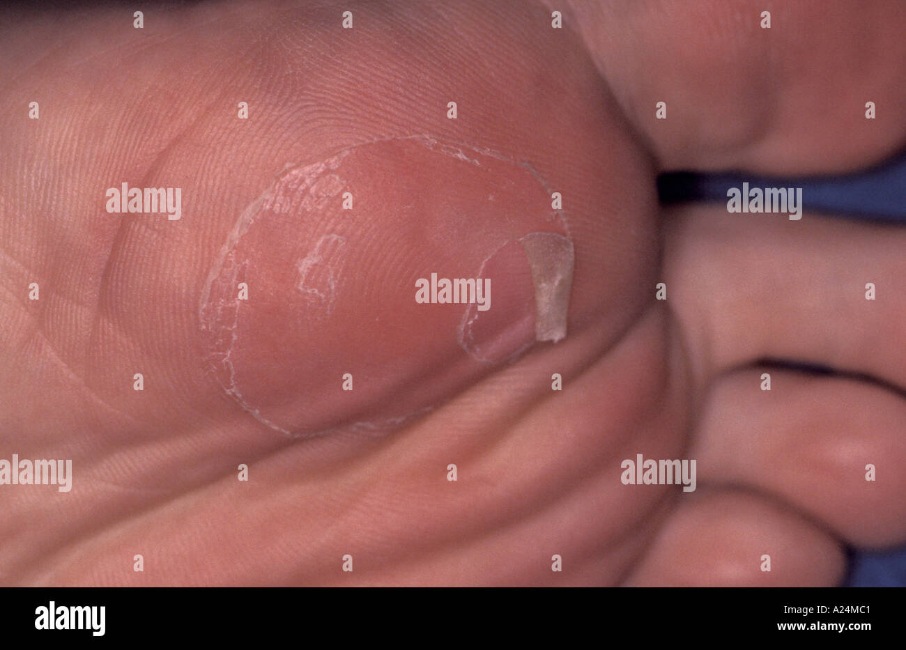 Blister foot hires stock photography and images Alamy