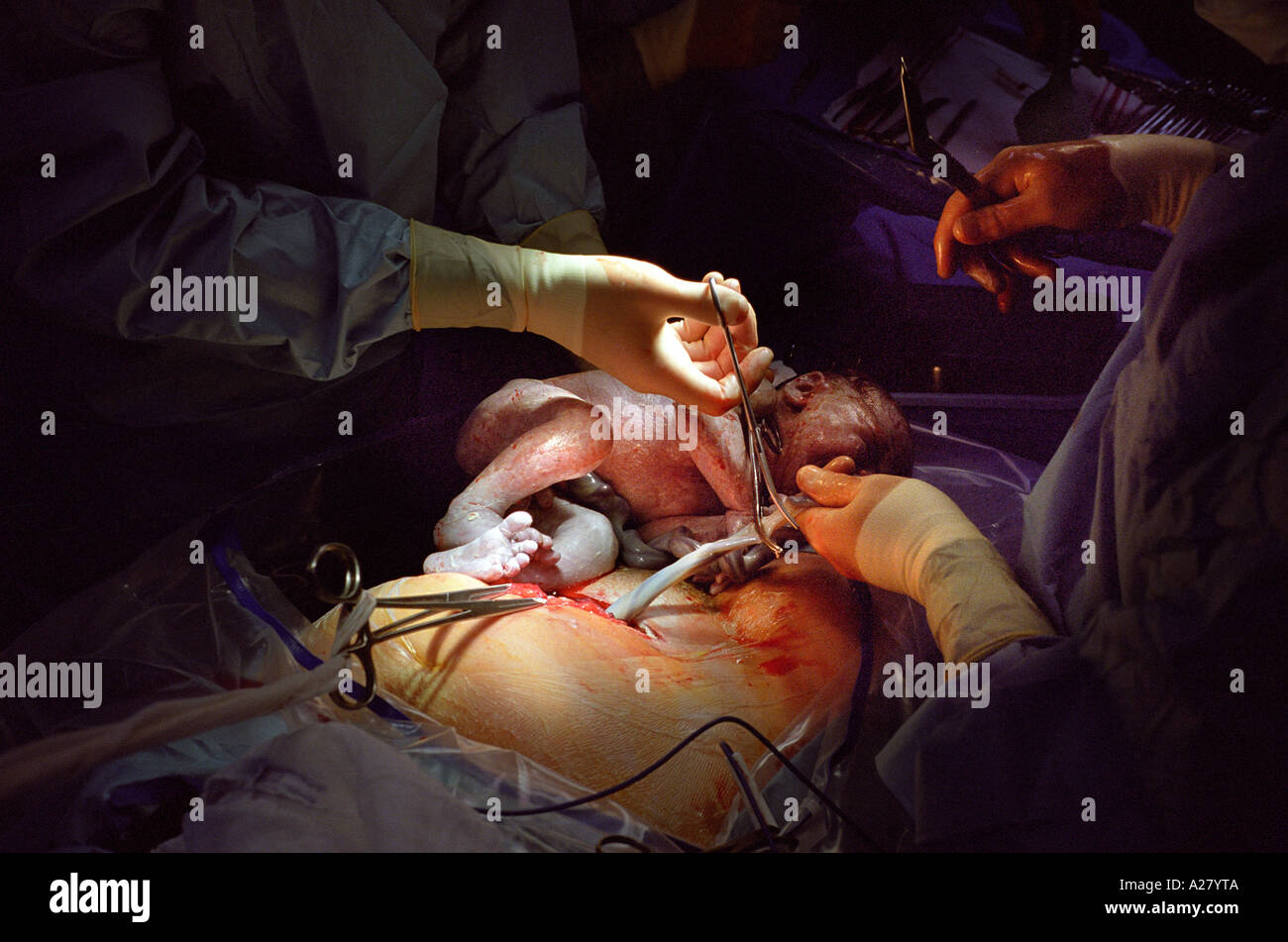 C-section birth Stock Photo